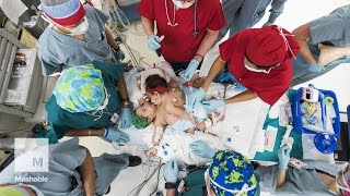 Conjoined twins survive 26hour separation surgery  Mashable [upl. by Lowney]