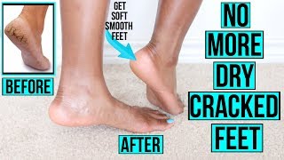 A Dermatologists Top 5 tips for foot fungus [upl. by Enomed]