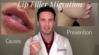 Lip Filler Migration Causes amp Prevention [upl. by Ranice408]