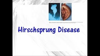 Hirschsprung disease [upl. by Bast]