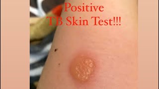 POSITIVE TB SKIN TEST [upl. by Marvel]