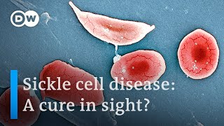 Sickle cell disease What it is and how to fight it  DW News [upl. by Burrill]