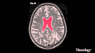 Standard chemoradiation for glioblastoma results in progressive brain volume loss [upl. by Vincenta]