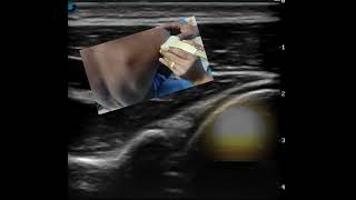 Scanning and Needling Nuances in Ultrasound guided glenohumeral joint injection [upl. by Agosto880]