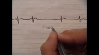 ECG simplified  Sinoatrial block [upl. by Aloeda300]