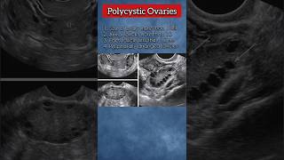 Polycystic Ovaries PCOs 💯❤️ polycysticovarysyndrome ovary pregnancy medical ultrasound health [upl. by Mellman]