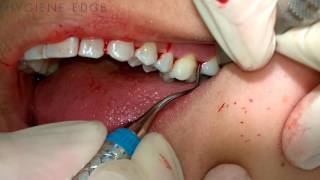 Gracey Instrumentation During Periodontal Therapy [upl. by Dionne]