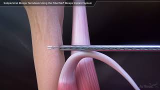 Subpectoral Biceps Tenodesis Using the FiberTak® Biceps Implant System [upl. by Lobel]