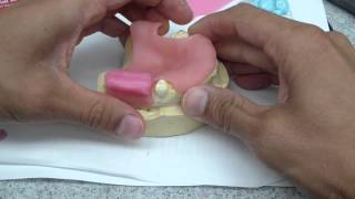 Immediate DentureRPD Jaw Relationship Record Fabrication [upl. by Torhert]