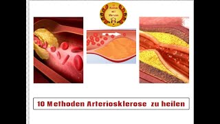 10 Methoden Arteriosklerose auf natürliche Weise zu heilen [upl. by Cichocki]