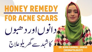 Honey for Acne Scars – Natural DIY Treatment For Acne  Shehad Se Pimples Aur Acne Scars Ka Ilaj [upl. by Maitland]