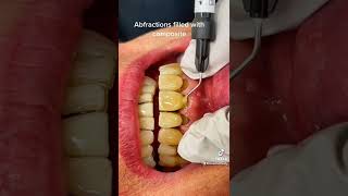 This Woman Drank Lemonade EVERY DAY for YEARS Dental Acid Erosion 😧 [upl. by Lsil]