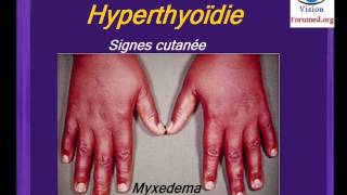 Hyperthyroidie Maladie de Basedow symptomes Endocrinologie Pathologie de la Thyroïde Cours medecine [upl. by Olocin660]