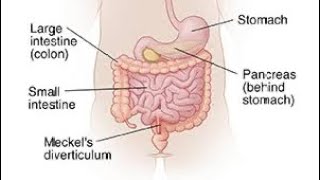 Mcqs on Meckel’s diverticulum surgerysurgeryeducationneetpg [upl. by Ximenes]