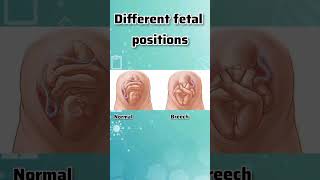 DIFFERENT FETAL POSITIONS IN THE WOMBdifferent fetal positions [upl. by Anabahs]