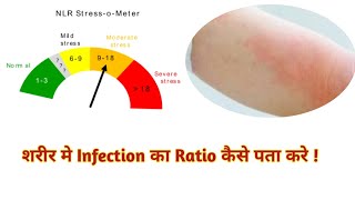 Neutrophil to lymphocyte ratio  Neutrophil lymphocyte ratio in hindi [upl. by Tryck133]