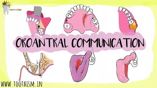 Oroantral Communication AND Fistula  Treatment options  Oral Surgery [upl. by Donetta]