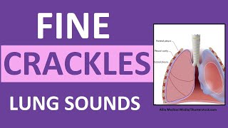 Crackles Fine Lung Sounds  Crackles and Rales Breath Sounds Abnormal [upl. by Edgerton]