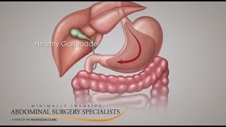 Gallbladder Symptoms [upl. by Georges]