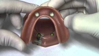 Implant Overdenture  Model Demonstration [upl. by Amej]