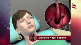 Aarogyamastu  Deviated Nasal Septum  23rd May 2017  ఆరోగ్యమస్తు [upl. by Shama]