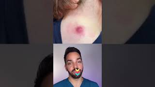 Popping a giant pimple boil shorts pimplepopper [upl. by Lledra120]