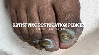 Satisfying Extreme Restoration Pedicure  Thick Toenails [upl. by Gaul]