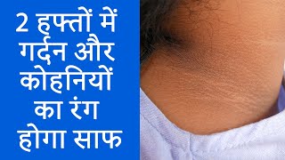 गर्दन और कोहनियों का कालापन दूर करने का आसान उपाय  Home Remedies for Black Neck And Elbows  NBT [upl. by Youngran]