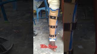 Tibia Brace [upl. by Pammie]