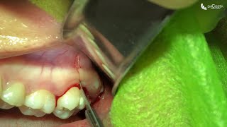 Exodontia de terceiro molar superior Upper wisdom tooth extraction [upl. by Llerut]