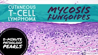 Mycosis Fungoides Cutaneous TCell Lymphoma 5Minute Pathology Pearls [upl. by Avram]