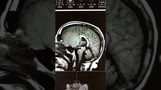 Cribriform plate meningioma [upl. by Rawdon366]