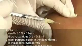 Celluform injection video [upl. by Caresa]