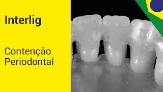 Interlig  Contenção Periodontal [upl. by Refennej460]