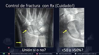 Fractura de Escafoides con tomografía CONE BEAM [upl. by Mindy]