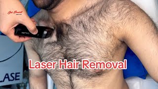 Laser Hair Removal Peshawar and Pakistan [upl. by Johnette]