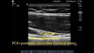 axillary nerve sonoanatomy [upl. by Neils28]