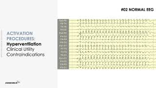 Learn to Read EEGs Part 1 [upl. by Ademla]