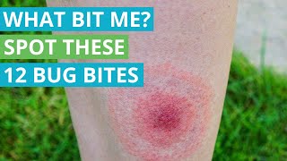 What Bit Me Spot These 12 Bug Bites [upl. by Eibloc423]