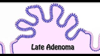 Animated Histology Colon Cancer Progression [upl. by Yeta543]