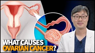 What Causes Ovarian Cancer How to Detect it Early and How to Treat it [upl. by Glynas]