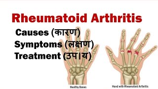 Rheumatoid Arthritis  Symptoms Causes Dignosis Treatment  Science Explored  Arthritis [upl. by Letsou408]