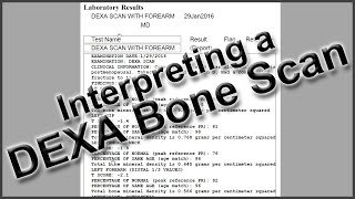 Interpreting a DEXA Bone Scan [upl. by Nosirb]