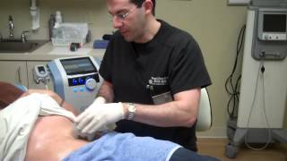 Exilis for Fat Reduction amp Skin Tightening on Stomach [upl. by Eidassac]