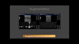 DVT Ultrasound Augmentation Technique [upl. by Homans]