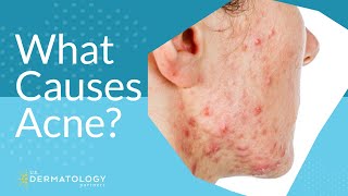 What Causes Acne  Explained by Dermatologist [upl. by Nilekcaj68]