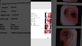 Bronchoscopy  inflammatory lesion [upl. by Idyh]