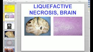 Medical School Pathology 2012 Session 003 Cell Adaptation Injury Death Lecture and Labmp4 [upl. by Donny847]