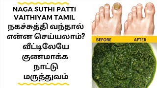 Paronychia Home Remedies Naga Suthi Patti Vaithiyam Tamil Naga Suthi Home Remedies In Tamil [upl. by Yhtamit]