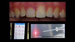 Webinar What Laser Dentistry Can Do For Your Practice  Diode Laser Webinar [upl. by Auohp]